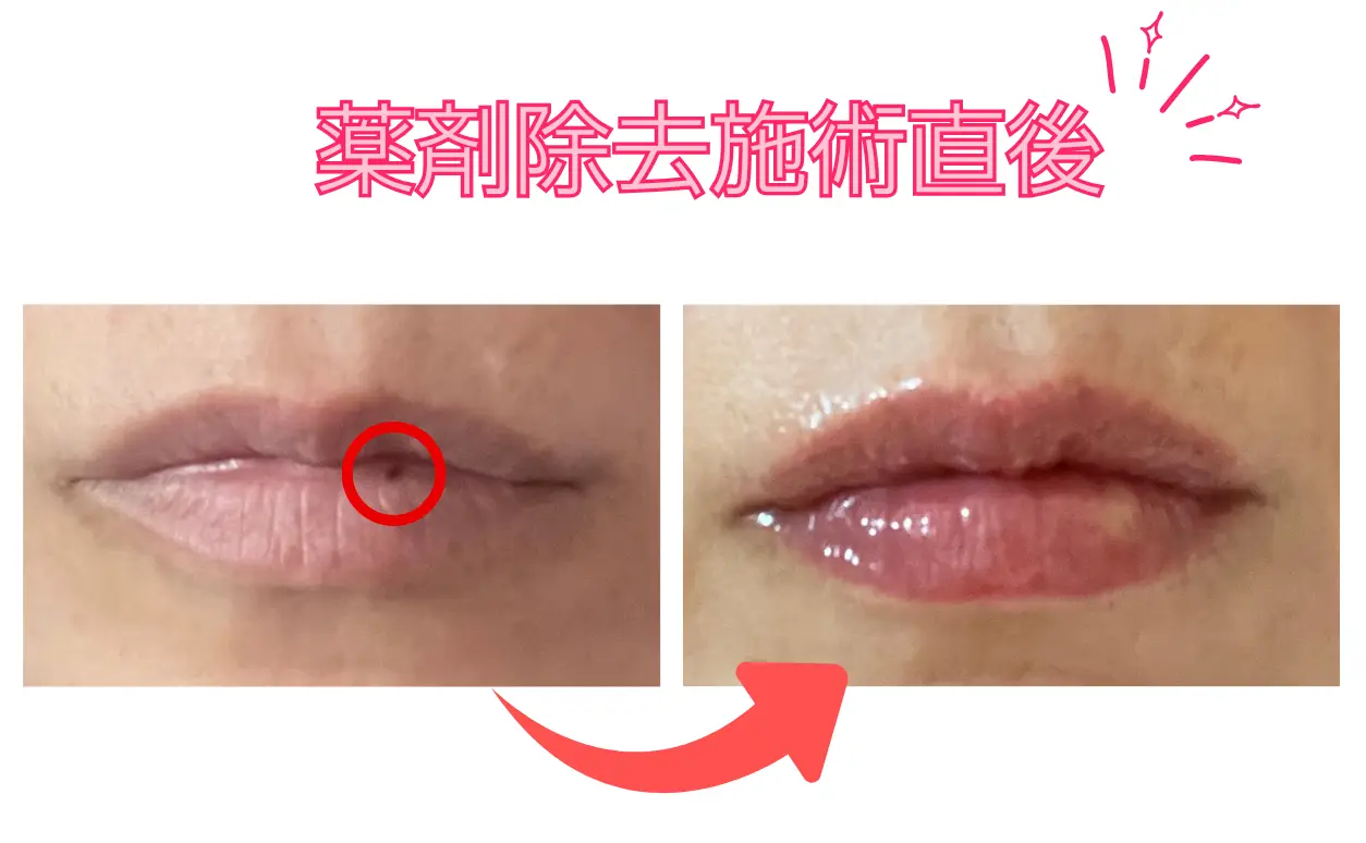 リップアート薬剤除去施術直後画像